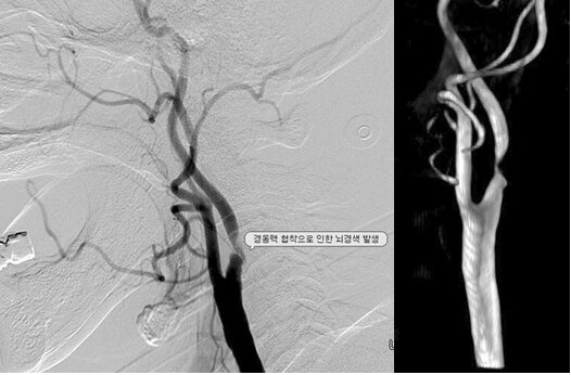 경동맥.jpg